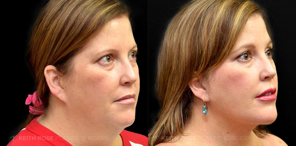 Chin Implants Before And After Photos J Keith Rose Md