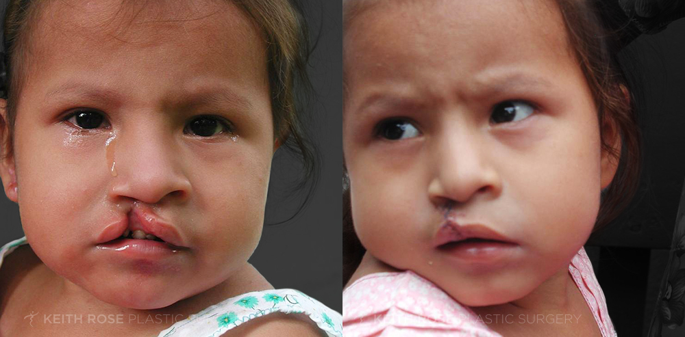 cleft lip before and after